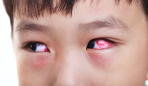 đau mắt đỏ có thể lây lan