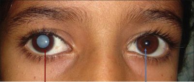 Nhược thị xảy ra khi một trong hai mắt không làm việc