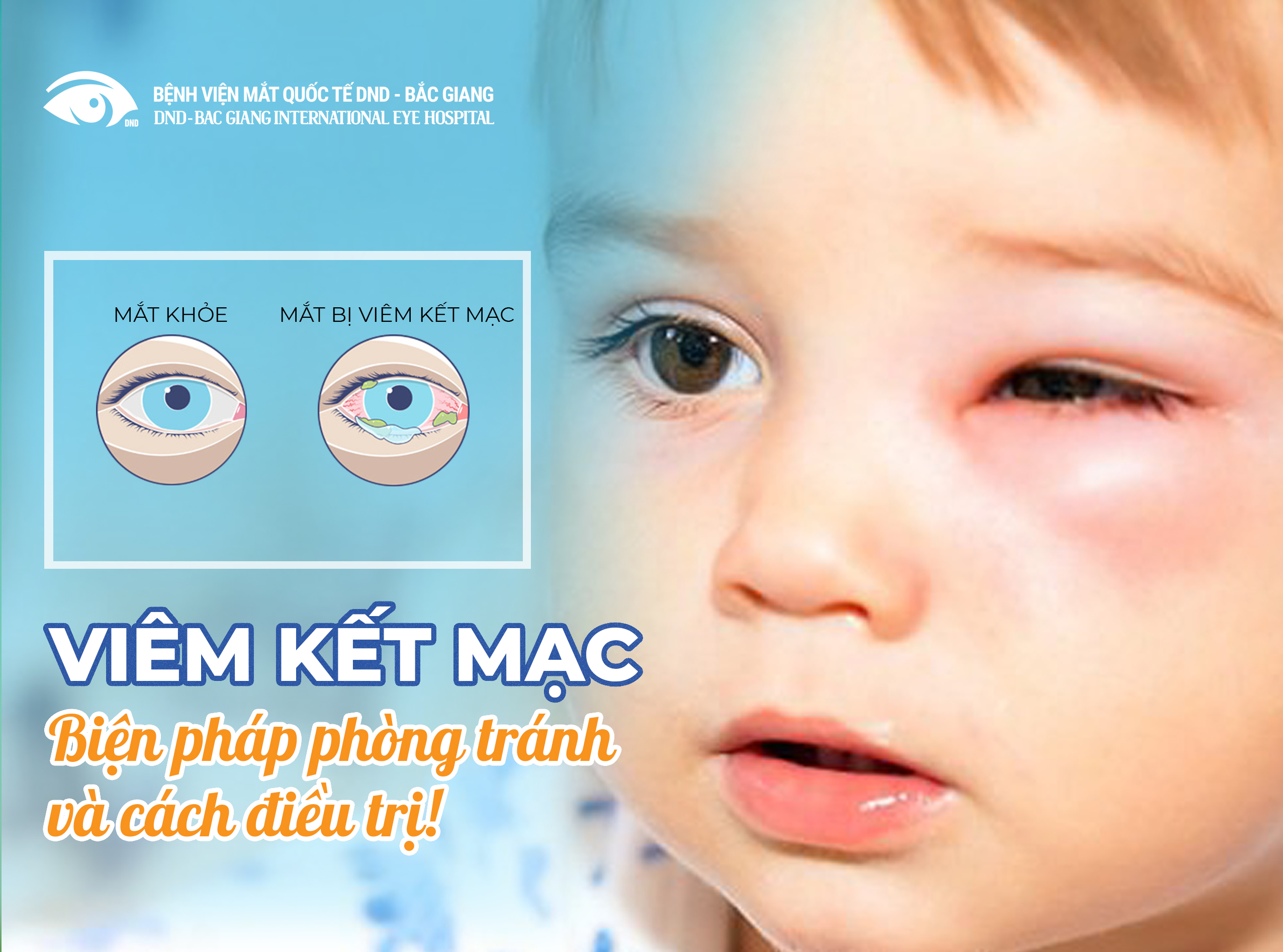 Điều trị viêm kết mạc mắt: Phương pháp hiệu quả và an toàn