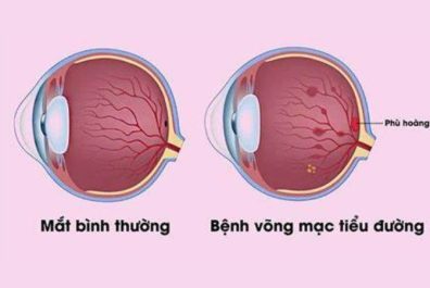 Hình ảnh minh họa bệnh võng mạc tiểu đường