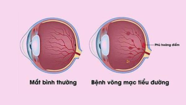 Hình ảnh minh họa bệnh võng mạc tiểu đường